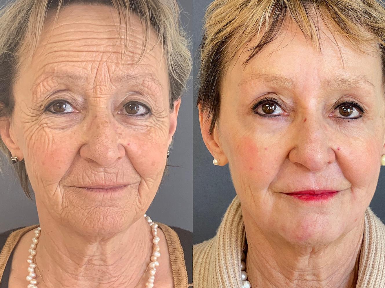 Neues vom Beauty Pro: Porentief nachgefragt